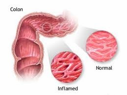 Colon Irritabile