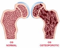 Osteoporosi